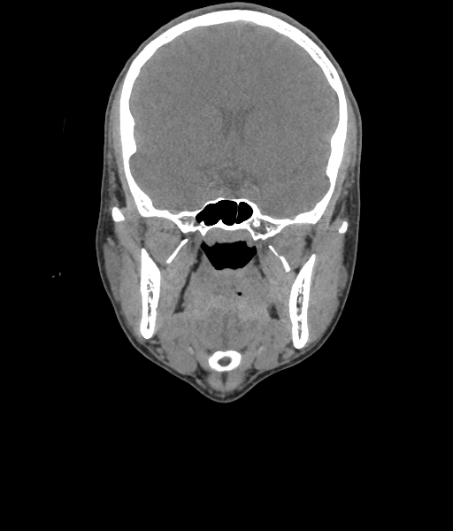 Nasal pyogenic granuloma (lobular capillary hemangioma) (Radiopaedia 85536-101244 Coronal non-contrast 99).jpg