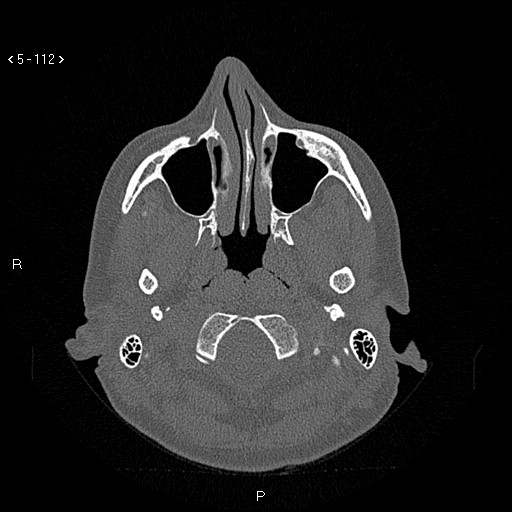File:Nasolabial cyst (Radiopaedia 75125-86194 Axial bone window 73).jpg