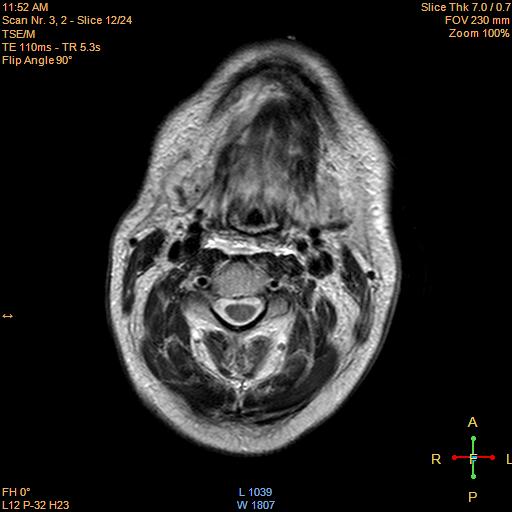 File:Nasopharyngeal carcinoma (Radiopaedia 22375-22403 Axial T2 12).jpg