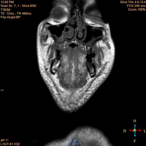 File:Nasopharyngeal carcinoma (Radiopaedia 22375-22403 Coronal T1 1).jpg