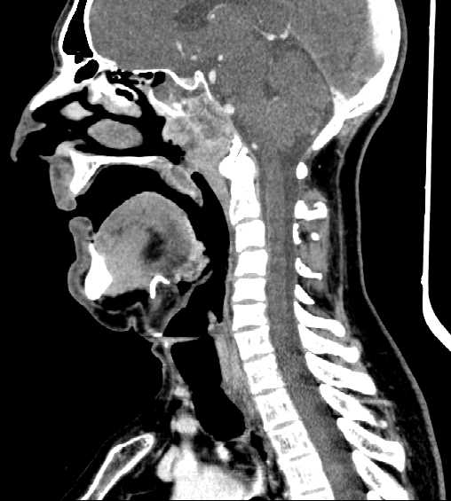 File:Nasopharyngeal carcinoma - infiltrating the clivus (Radiopaedia 62583-70875 C 26).jpg