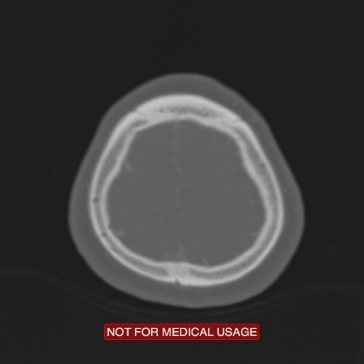 Nasopharyngeal carcinoma recurrence - skull base destruction (Radiopaedia 29107-29490 Axial bone window 15).jpg