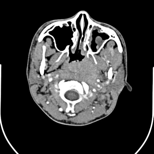 Nasopharyngeal carcinoma with skull base invasion (Radiopaedia 53415-59705 A 56).jpg