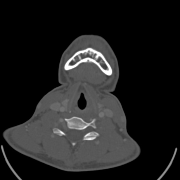 Nasopharyngeal carcinoma with skull base invasion (Radiopaedia 53415-59705 Axial bone window 149).jpg