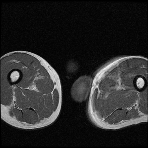 File:Necrotizing epididymo-orchitis with intra-testicular abscess (Radiopaedia 29397-29860 Axial T1 C+ 18).jpg