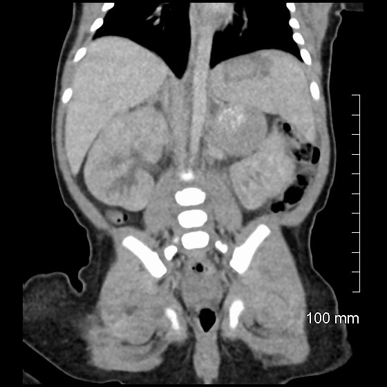File:Neonatal neuroblastoma (Radiopaedia 56651-63438 Coronal non-contrast 33).jpg