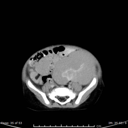 File:Nephroblastomatosis (Radiopaedia 41934-44935 A 35).jpg
