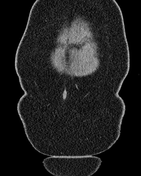 File:Nephrostomy for urosepsis (Radiopaedia 26180-26330 non-contrast 9).jpg