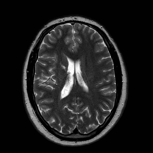 File:Neuro-Behcet's disease (Radiopaedia 21557-21506 Axial T2 17).jpg