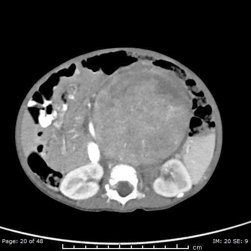 File:Neuroblastoma (Radiopaedia 41472-44355 A 20).jpg