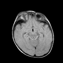 File:Neurofibromatosis type 1 (Radiopaedia 30089-30671 Axial FLAIR 10).jpg