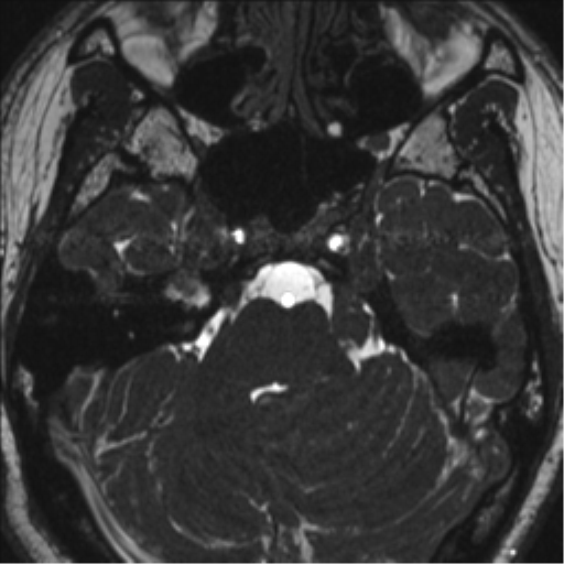 Neurofibromatosis type 2 (Radiopaedia 44936-48838 E 36).png