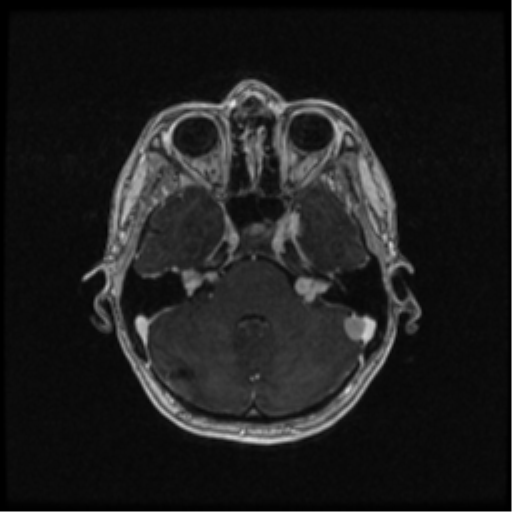 Neurofibromatosis type 2 (Radiopaedia 45229-49244 Axial T1 C+ 41).png