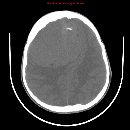 File:Neurofibromatosis type 2 (Radiopaedia 8953-9732 Axial non-contrast 24).jpg