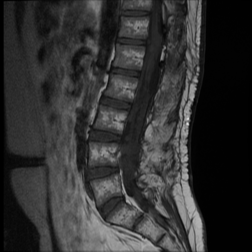 File:Neurofibromatosis type 2 (spinal manifestations) (Radiopaedia 53943-60070 F 7).png