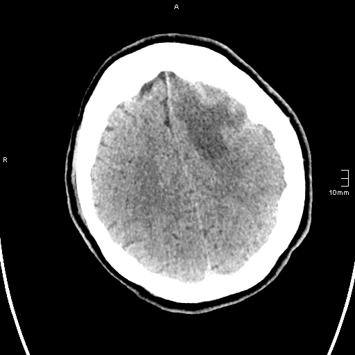 File:Neurotoxoplasmosis - concentric target sign (Radiopaedia 70644-80783 Axial non-contrast 29).jpg