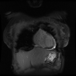 File:Non-compaction of the left ventricle (Radiopaedia 38868-41062 Coronal SSFP 2D FS 15).jpg