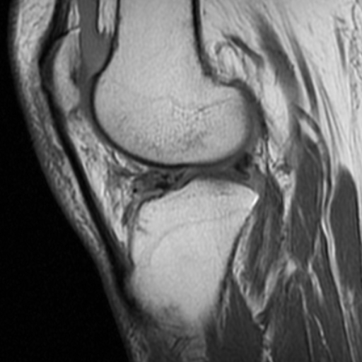 File:Non-displaced patella fracture (Radiopaedia 15932-15582 Sagittal T1 13).jpg