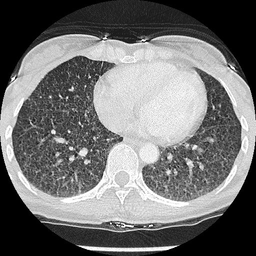 File:Non-small cell lung cancer with miliary metastases (Radiopaedia 23995-24193 Axial lung window 16).jpg