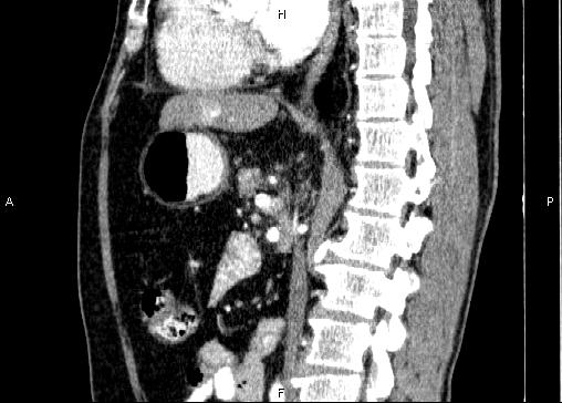Non-syndromic pancreatic endocrine tumor (Radiopaedia 86958-103178 E 52).jpg