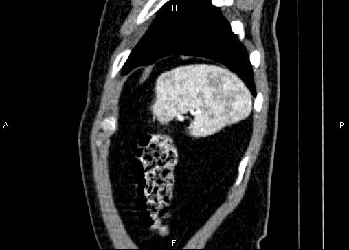 Non-syndromic pancreatic endocrine tumor (Radiopaedia 86958-103178 E 92).jpg