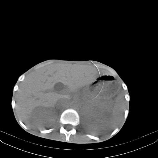File:Non hodgkin lymphoma of the mediastinum (Radiopaedia 20814-20729 Axial non-contrast 39).jpg