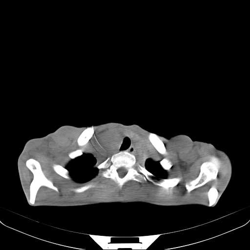 File:Non hodgkin lymphoma of the mediastinum (Radiopaedia 20814-20729 Axial non-contrast 4).jpg
