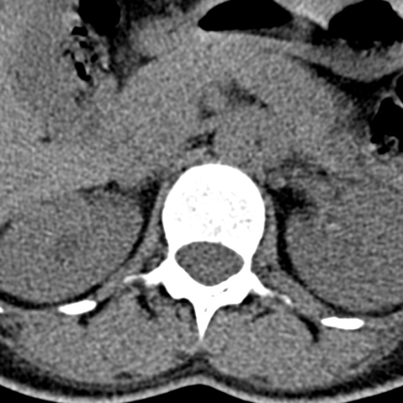 Normal CT lumbar spine (Radiopaedia 53981-60118 Axial non-contrast 20).jpg