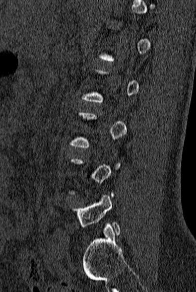 File:Normal CT lumbar spine (Radiopaedia 53981-60118 Sagittal bone window 69).jpg