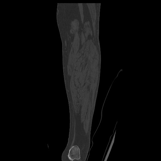 Normal CT tibia and fibula (Radiopaedia 51195-56848 Coronal non-contrast 51).jpg
