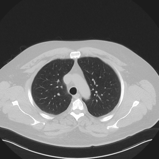 Normal HRCT (Radiopaedia 40797-43458 Axial lung window 17).png