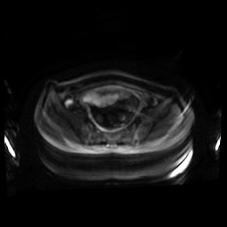 Normal MRI abdomen in pregnancy (Radiopaedia 88001-104541 Axial DWI 52).jpg