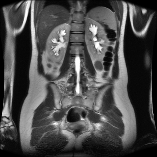 File:Normal MRI abdomen in pregnancy (Radiopaedia 88001-104541 Coronal T2 23).jpg