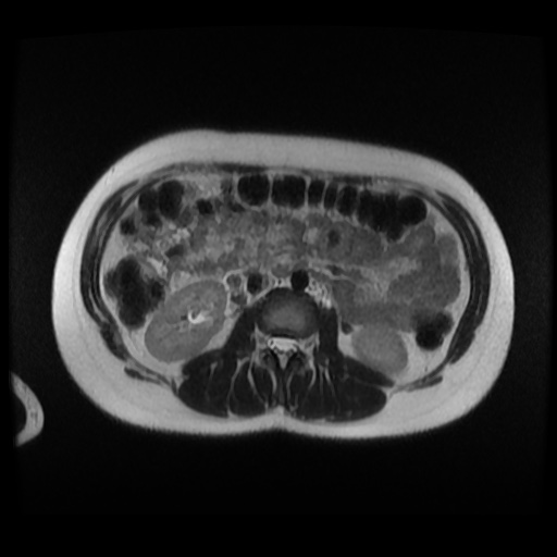 Normal MRI abdomen in pregnancy (Radiopaedia 88003-104546 Axial T2 15).jpg