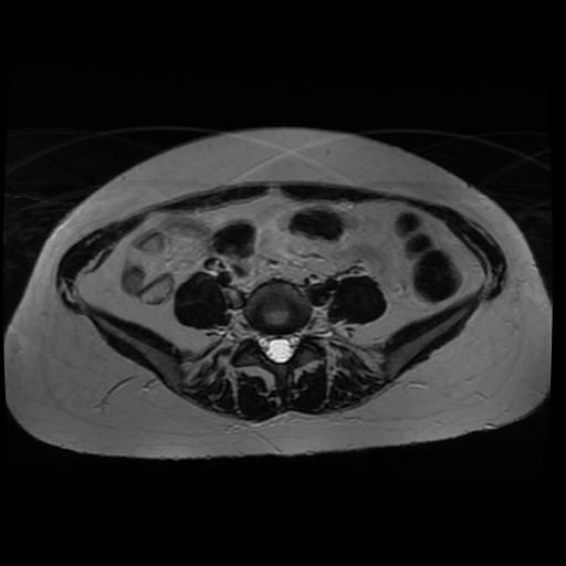 Normal MRI abdomen in pregnancy (Radiopaedia 88005-104548 Axial T2 12).jpg