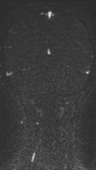 Normal MRI brain with MRV- teenager (Radiopaedia 49425-54553 Coronal MRV 180).jpg