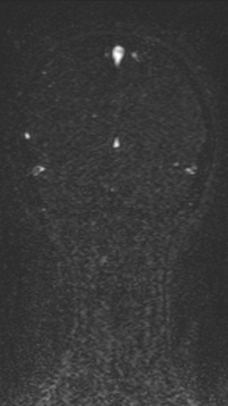Normal MRI brain with MRV- teenager (Radiopaedia 49425-54553 Coronal MRV 195).jpg