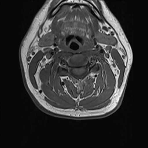 File:Normal MRI cervical spine (infection protocol) (Radiopaedia 53916-60039 Axial 22).png