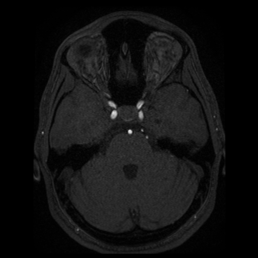 Normal brain MRA (Radiopaedia 41046-43793 Axial MRA 71).png