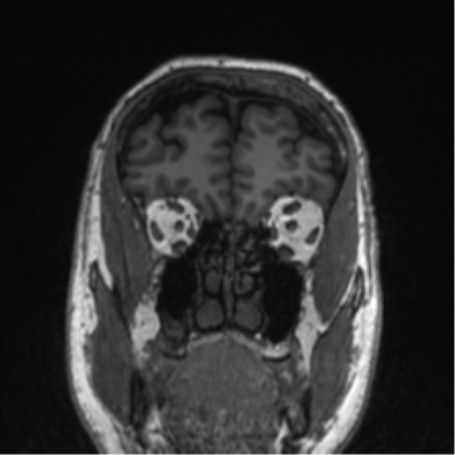 Normal brain MRI (non-focal epilepsy protocol) (Radiopaedia 53917-60040 Coronal T1 54).png