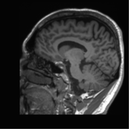 Normal brain MRI (non-focal epilepsy protocol) (Radiopaedia 53917-60040 Sagittal T1 28).png