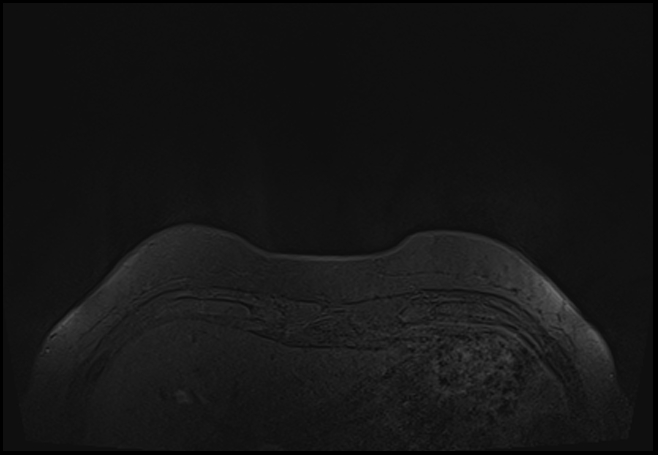File:Normal breast MRI - dense breasts (Radiopaedia 80454-93850 Axial T1 6).jpg