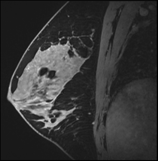 Normal breast MRI - dense breasts (Radiopaedia 80454-93850 I 103).jpg