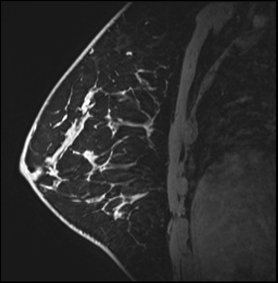 Normal breast MRI - dense breasts (Radiopaedia 80454-93850 I 123).jpg