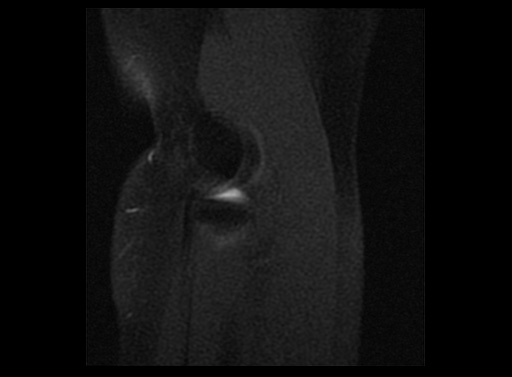 File:Normal elbow arthrograms (Radiopaedia 75550-86805 Sagittal T1 fat sat 4).jpg