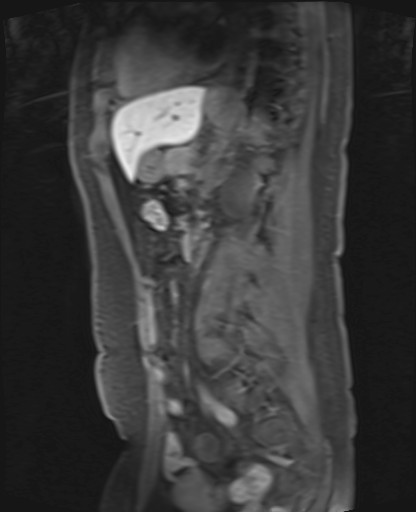 File:Normal hepatobiliary phase liver MRI (Radiopaedia 58968-66230 C 48).jpg