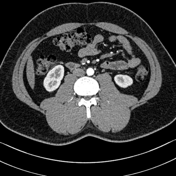 Normal kidneys on 4-phase CT study (Radiopaedia 25889-26038 B 66).jpg