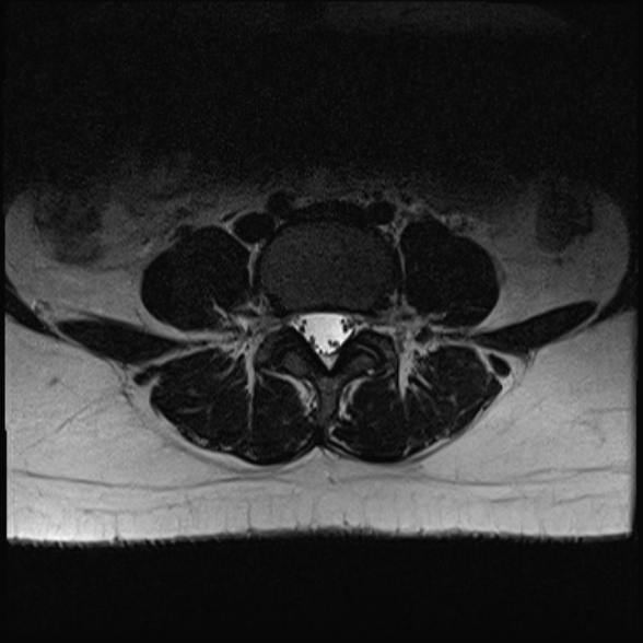 File:Normal lumbar spine MRI- 3 T (Radiopaedia 53280-59250 Axial T2 19).jpg