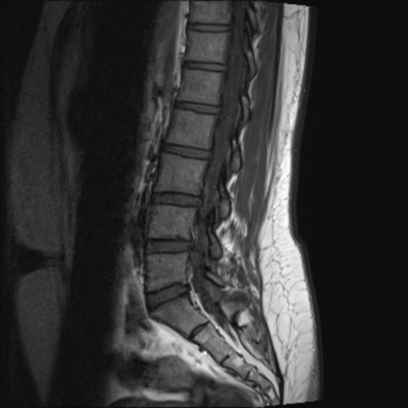 File:Normal lumbar spine MRI- 3 T (Radiopaedia 53280-59250 Sagittal T1 11).jpg