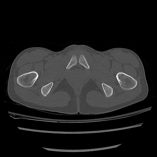 Normal pelvis CT (Radiopaedia 51471-57236 Axial bone window 91).jpg
